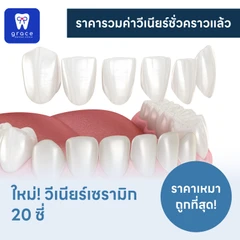 ทำวีเนียร์เซรามิก E-Max Press 20 ซี่