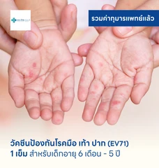 วัคซีนป้องกันโรคมือ เท้า ปาก 1 เข็ม สำหรับเด็กอายุ 6 เดือน-5 ปี