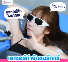 เลเซอร์กำจัดขนรักแร้ 4 พลังงาน เครื่องแท้ Primelase จากสเปน 1 ครั้ง (1 สิทธิ์/ท่าน)