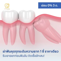 ผ่าฟันคุดทุกระดับความยาก 1 ซี่ ราคาเดียว