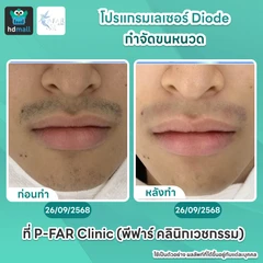 โปรแกรมเลเซอร์ Diode กำจัดขนหนวด 6 ครั้ง