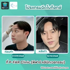 โปรแกรมฉีดโบท็อกซ์ 100 ยูนิต (หน้า)