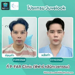 โปรแกรมเมโสหน้า Juvelook 6 ซีซี