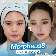 โปรแกรม Morpheus 8 ยกกระชับ (หน้า + คอ)