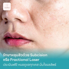 รักษาหลุมสิวด้วย Subcision หรือ Fractional Laser