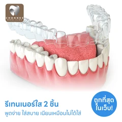 ทำรีเทนเนอร์แบบใส 2 ชิ้น