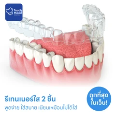 ทำรีเทนเนอร์แบบใส 2 ชิ้น