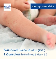 วัคซีนป้องกันโรคมือ เท้า ปาก 2 เข็ม (ครบโดส) สำหรับเด็กอายุ 6 เดือน-5 ปี