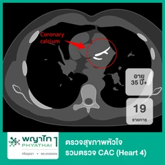 ตรวจสุขภาพหัวใจ 19 รายการ รวมตรวจ CAC (Heart 4) (35 ปีขึ้นไป)