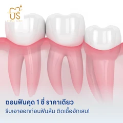 ถอนฟันคุด 1 ซี่ ราคาเดียว