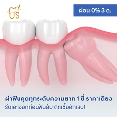 ผ่าฟันคุดทุกระดับความยาก 1 ซี่ ราคาเดียว