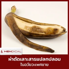 ผ่าตัดเลาะสารแปลกปลอมจากอวัยวะเพศชาย (ฉีดยาชา)