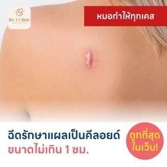 ฉีดรักษาแผลเป็นคีลอยด์ ขนาดเส้นผ่านศูนย์กลางไม่เกิน 1 ซม. 1 จุด 1 ครั้ง