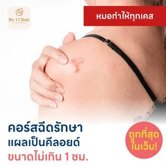 คอร์สฉีดรักษาแผลเป็นคีลอยด์ ขนาดเส้นผ่านศูนย์กลางไม่เกิน 1 ซม. 1 จุด 5 ครั้ง