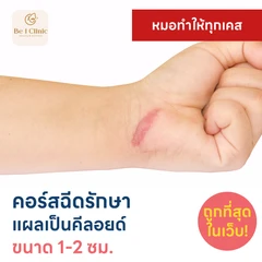 คอร์สฉีดรักษาแผลเป็นคีลอยด์ ขนาดเส้นผ่านศูนย์กลาง 1-2 ซม. 1 จุด 5 ครั้ง