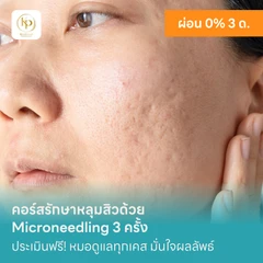 คอร์สรักษาหลุมสิวด้วย Microneedling 3 ครั้ง