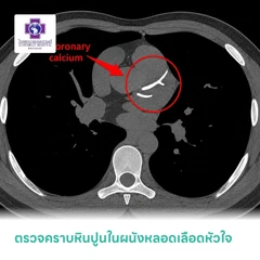 ตรวจคราบหินปูนในผนังหลอดเลือดหัวใจ (CT Calcium Scoring) (สำหรับทุกช่วงวัย)