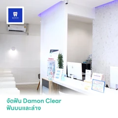จัดฟัน Damon Clear ฟันบนและล่าง