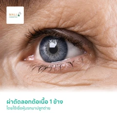 ผ่าตัดลอกต้อเนื้อ 1 ข้าง โดยใช้เยื่อหุ้มรกมาปลูกถ่าย