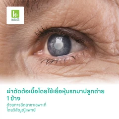 ผ่าตัดต้อเนื้อโดยใช้เยื่อหุ้มรกมาปลูกถ่าย 1 ข้าง (Amniotic Graft) ด้วยการฉีดยาชาเฉพาะที่ โดยวิสัญญีแพทย์