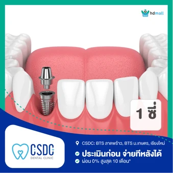 ทำรากฟันเทียม ยี่ห้อ Astra Tech 1 ซี่