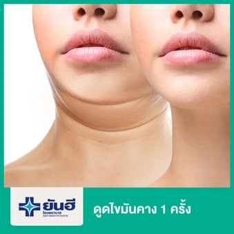ดูดไขมันคาง 1 ครั้ง