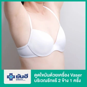 โปรแกรมดูดไขมันด้วยเครื่อง Vaser บริเวณรักแร้ 2 ข้าง 1 ครั้ง