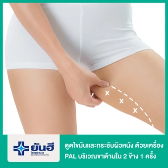 โปรแกรมดูดไขมันและกระชับผิวหนัง ด้วยเครื่อง PAL และ Renuvion บริเวณขาด้านใน 2 ข้าง 1 ครั้ง