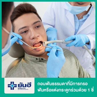 ถอนฟันธรรมดาที่มีการกรอฟันหรือแต่งกระดูกร่วมด้วย 1 ซี่