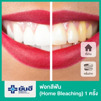 ฟอกสีฟัน (Home Bleaching) ครึ่งปาก 1 ครั้ง