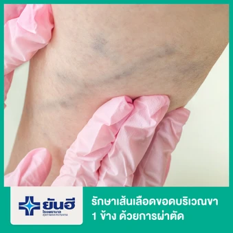 รักษาเส้นเลือดขอดบริเวณขา 1 ข้าง ด้วยการผ่าตัด