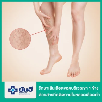 รักษาเส้นเลือดขอดบริเวณขา 1 ข้าง ด้วยสารยึดติดภายในหลอดเลือดดำ