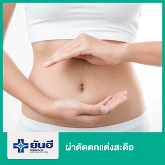 ผ่าตัดตกแต่งสะดือ