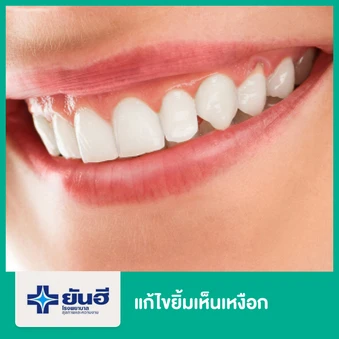 แก้ไขยิ้มเห็นเหงือก