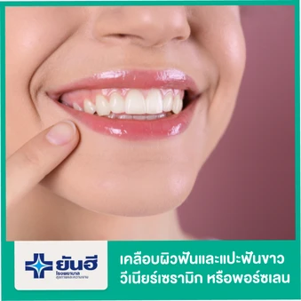 เคลือบผิวฟันและแปะฟันขาว ด้วยวีเนียร์เซรามิกหรือพอร์ซเลน Empress Esthetics 1 ซี่