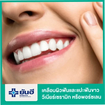 เคลือบผิวฟันและแปะฟันขาว ด้วยวีเนียร์เซรามิกหรือพอร์ซเลน EMax 1 ซี่