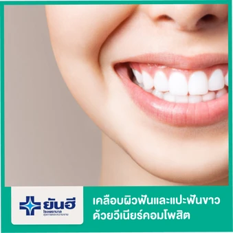 เคลือบผิวฟันและแปะฟันขาว ด้วยวีเนียร์คอมโพสิต (Partial Composite Veneer from Caries) 1 ซี่