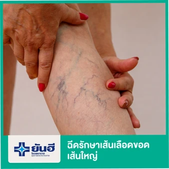 ฉีดรักษาเส้นเลือดขอด เส้นใหญ่