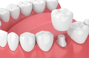 ทำครอบฟัน 1 ซี่