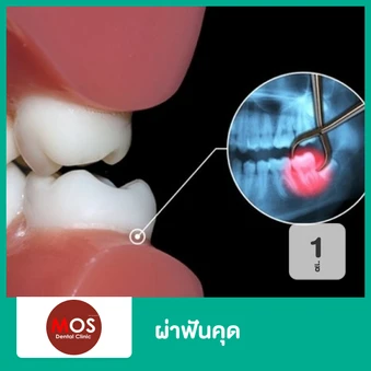 ผ่าฟันคุด ทุกประเภท 1 ซี่