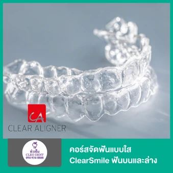 คอร์สจัดฟันแบบใส ClearSmile ฟันบนและล่าง