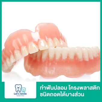 ทำฟันปลอมโครงพลาสติก ชนิดถอดได้บางส่วน 1 ชิ้น รวมฟัน 1 ซี่ สำหรับฟันบนหรือล่าง