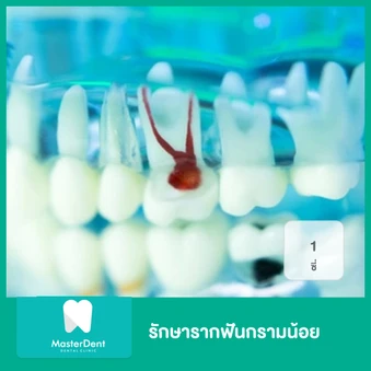 รักษารากฟันกรามน้อย 1 ซี่