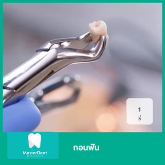 ถอนฟัน 1 ซี่