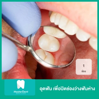 อุดฟัน เพื่อปิดช่องว่างฟันห่าง 1 ช่อง