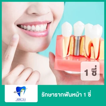 รักษารากฟันหน้า 1 ซี่