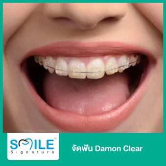 จัดฟันลวด Damon Clear