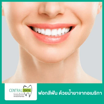 ฟอกสีฟันที่คลินิก ด้วยระบบ Cool Light น้ำยาจากอเมริกา