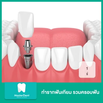 ทำรากฟันเทียม รวมครอบฟัน 1 ซี่