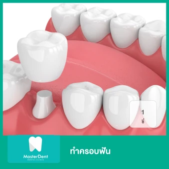 ทำครอบฟัน 1 ซี่